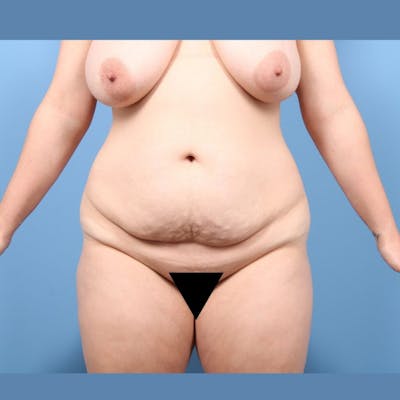 Mommy Makeover Before & After Gallery - Patient 240674 - Image 1
