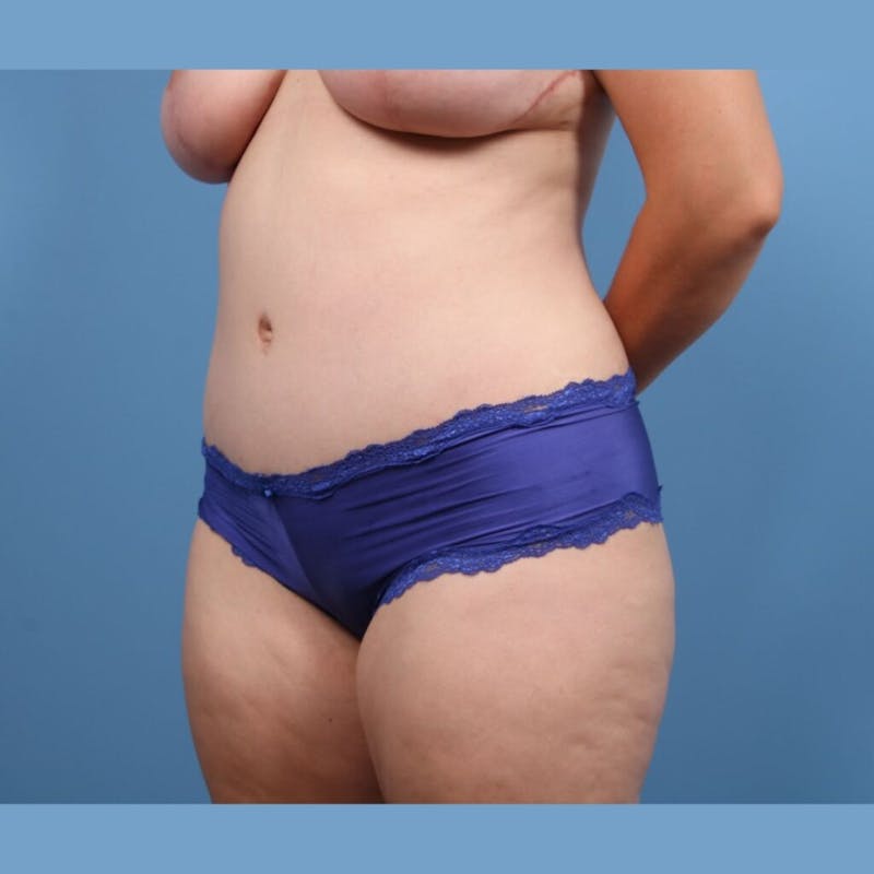Mommy Makeover Before & After Gallery - Patient 240674 - Image 4