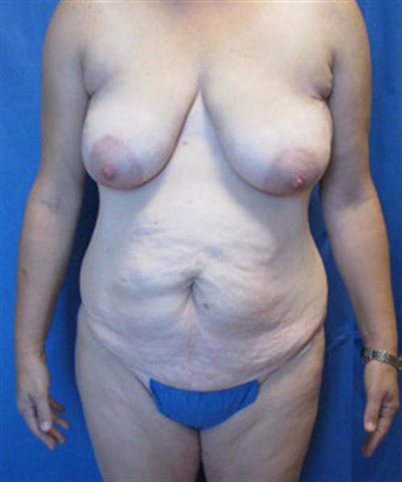 Mommy Makeover Before & After Gallery - Patient 942885 - Image 1