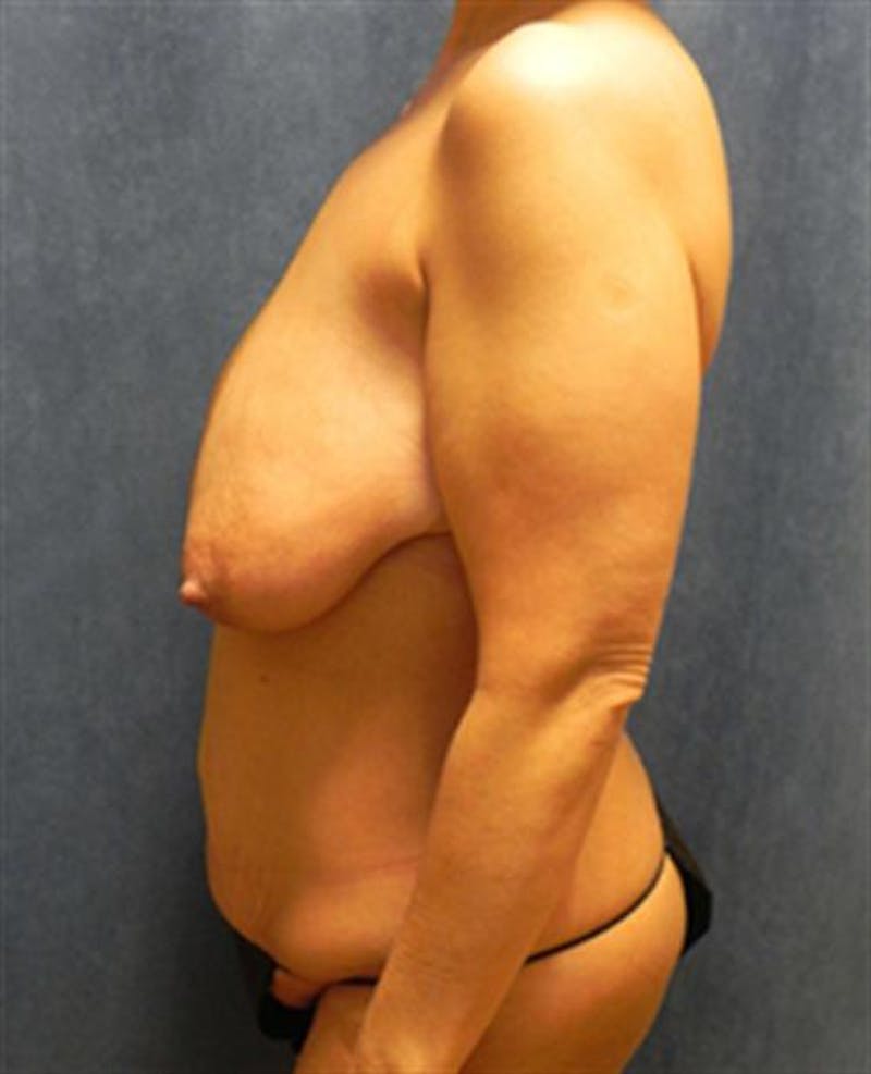 Mommy Makeover Before & After Gallery - Patient 250416 - Image 3
