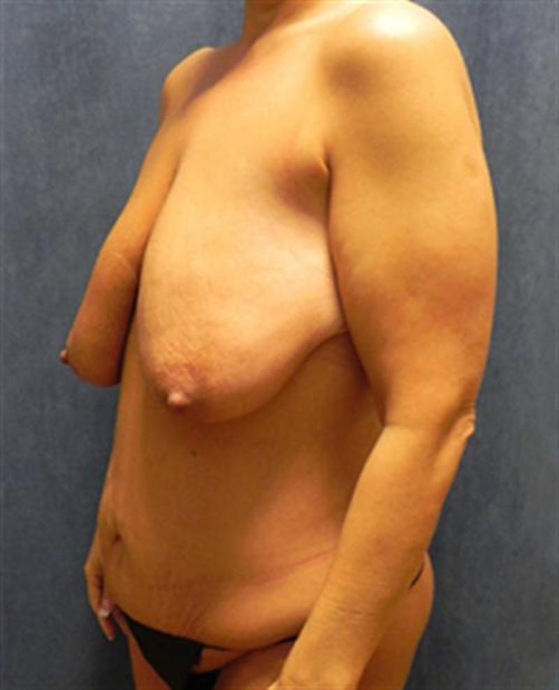 Mommy Makeover Before & After Gallery - Patient 250416 - Image 5