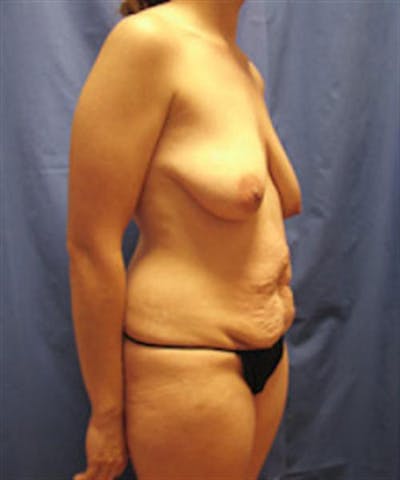 Mommy Makeover Before & After Gallery - Patient 115559 - Image 1