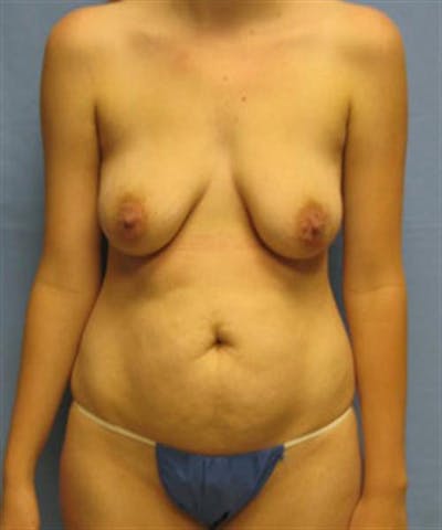 Mommy Makeover Before & After Gallery - Patient 209496 - Image 1