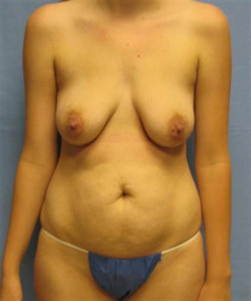 Mommy Makeover Before & After Gallery - Patient 209496 - Image 1