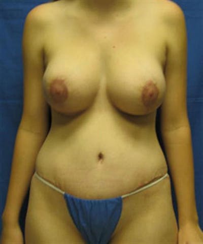 Mommy Makeover Before & After Gallery - Patient 209496 - Image 2