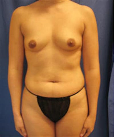 Mommy Makeover Before & After Gallery - Patient 147771 - Image 1