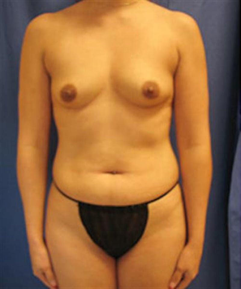 Mommy Makeover Before & After Gallery - Patient 147771 - Image 1