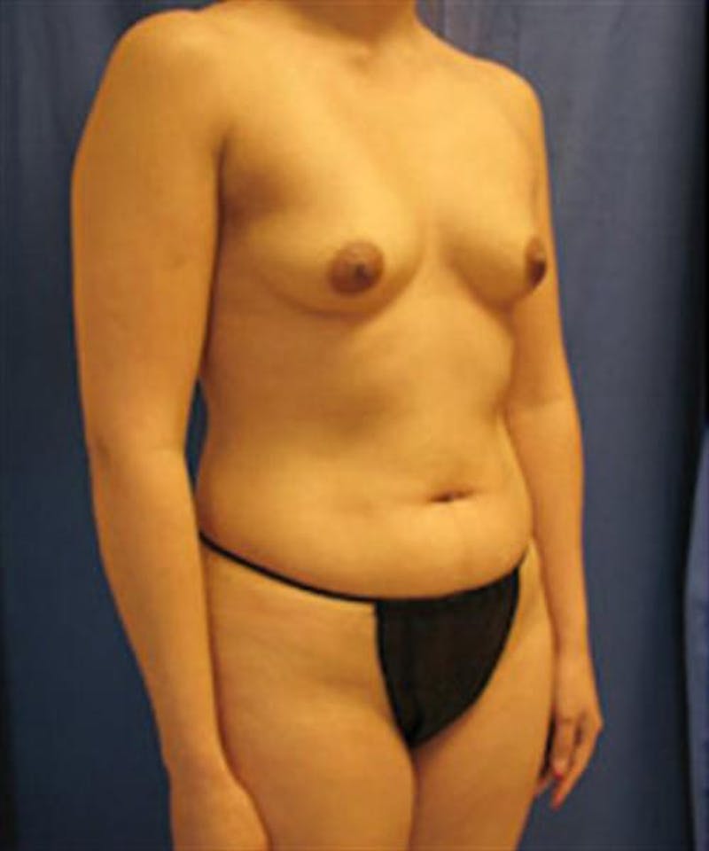 Mommy Makeover Before & After Gallery - Patient 147771 - Image 3