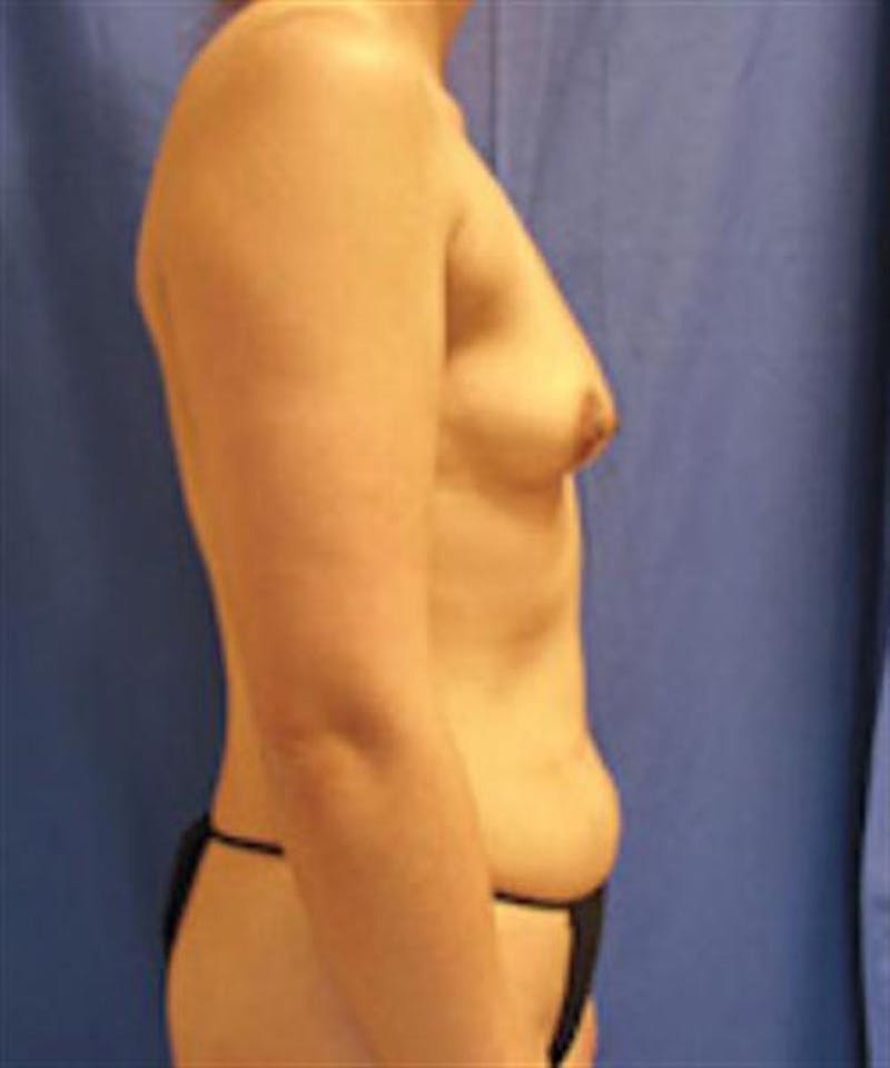 Mommy Makeover Before & After Gallery - Patient 147771 - Image 5