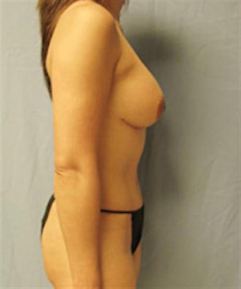 Mommy Makeover Before & After Gallery - Patient 147771 - Image 6