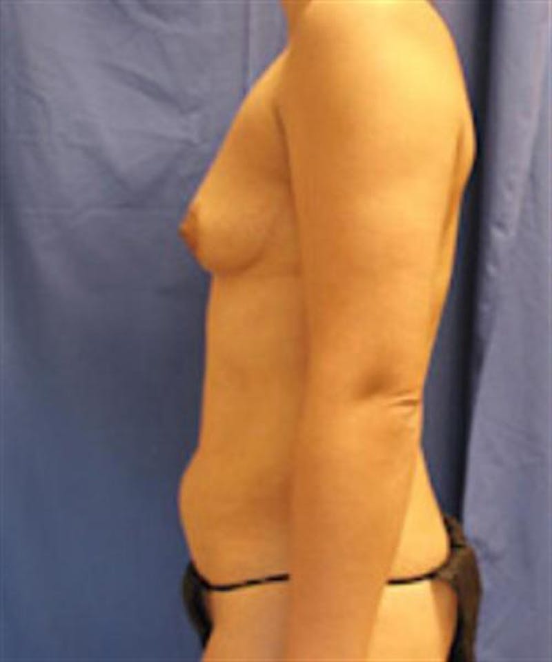 Mommy Makeover Before & After Gallery - Patient 147771 - Image 7