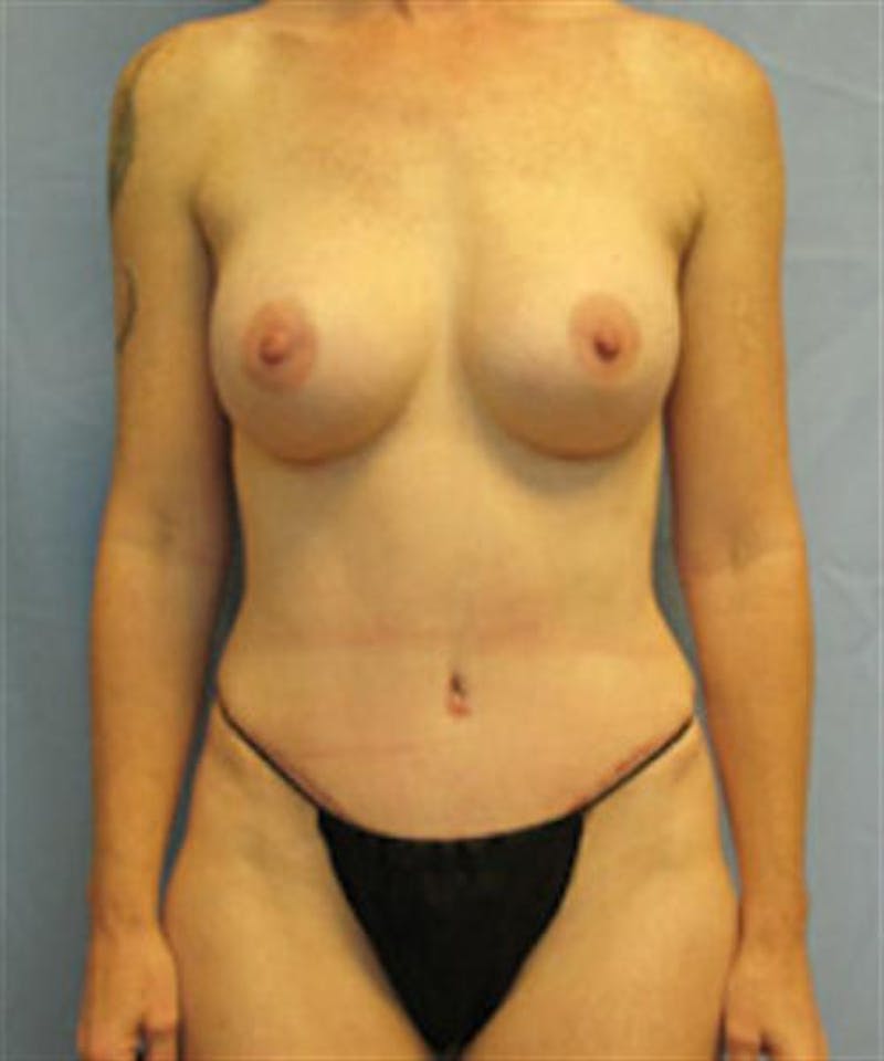 Mommy Makeover Before & After Gallery - Patient 133236 - Image 2