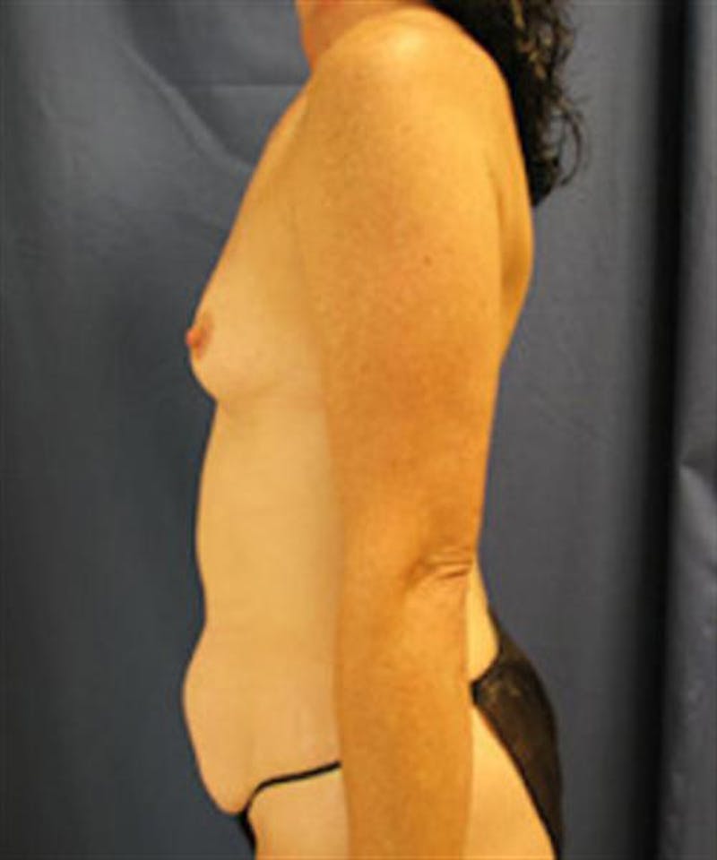 Mommy Makeover Before & After Gallery - Patient 133236 - Image 3