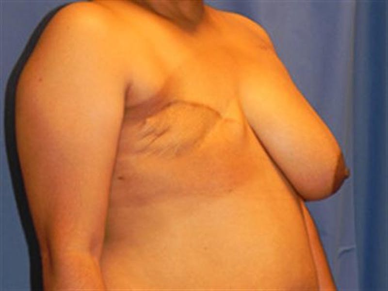 DIEP Flap Before & After Gallery - Patient 426912 - Image 1