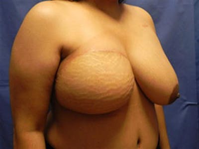 DIEP Flap Before & After Gallery - Patient 426912 - Image 2