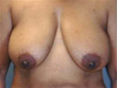 DIEP Flap Before & After Gallery - Patient 183290 - Image 1