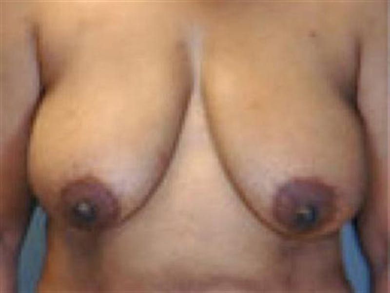 DIEP Flap Before & After Gallery - Patient 183290 - Image 1