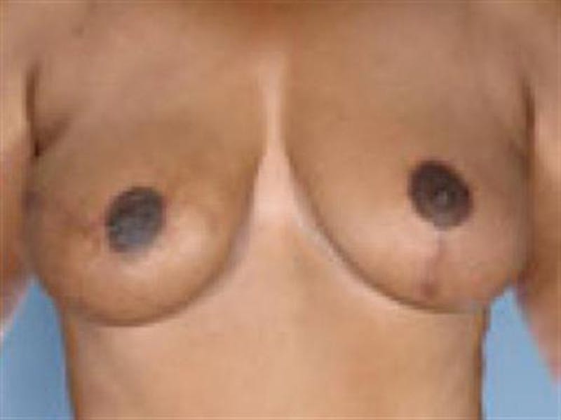 DIEP Flap Before & After Gallery - Patient 183290 - Image 2