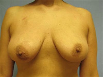 DIEP Flap Before & After Gallery - Patient 219259 - Image 1