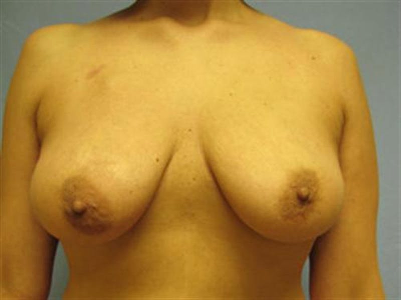 DIEP Flap Before & After Gallery - Patient 219259 - Image 1