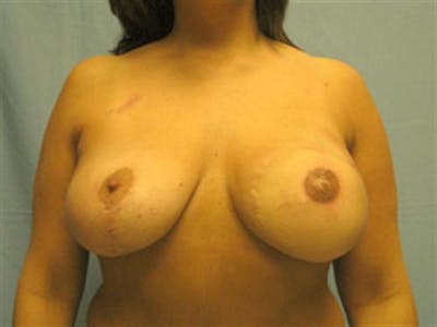 DIEP Flap Before & After Gallery - Patient 219259 - Image 2