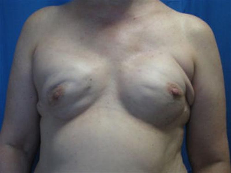 DIEP Flap Before & After Gallery - Patient 386740 - Image 1