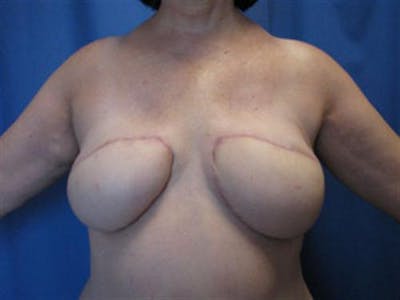DIEP Flap Before & After Gallery - Patient 386740 - Image 2