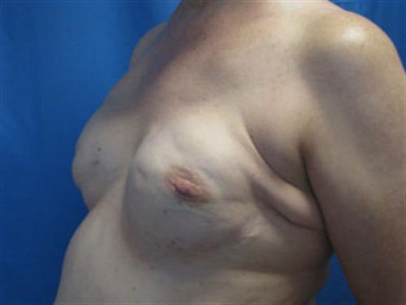 DIEP Flap Before & After Gallery - Patient 386740 - Image 3