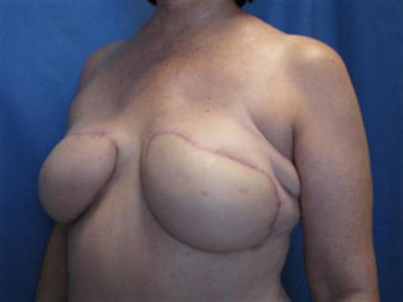 DIEP Flap Before & After Gallery - Patient 386740 - Image 4