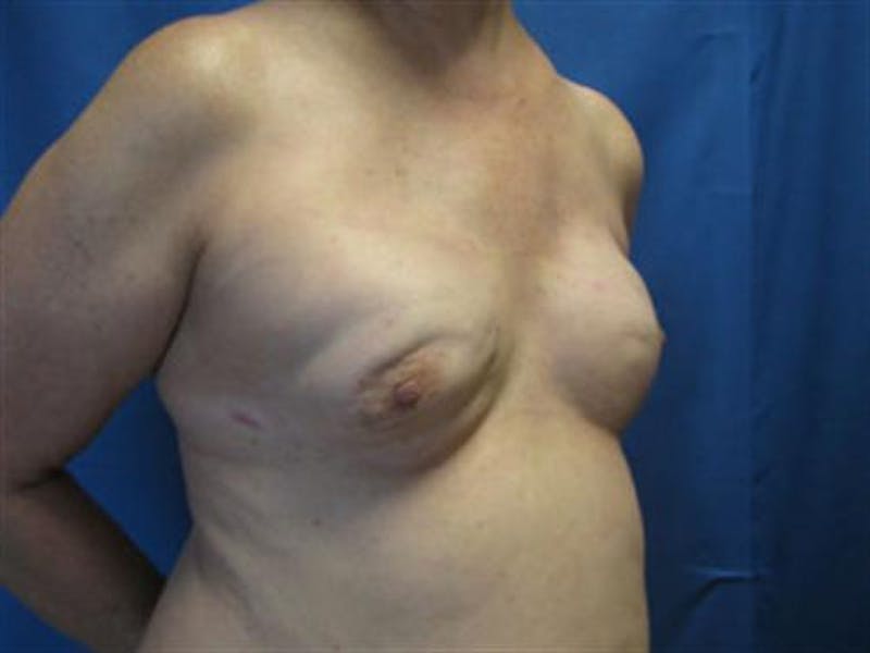 DIEP Flap Before & After Gallery - Patient 386740 - Image 5