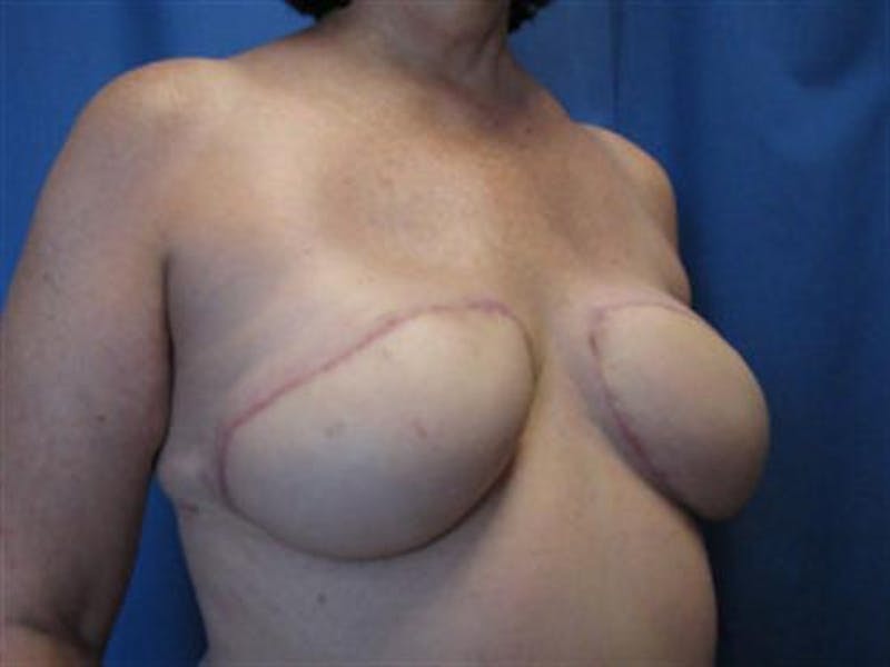 DIEP Flap Before & After Gallery - Patient 386740 - Image 6