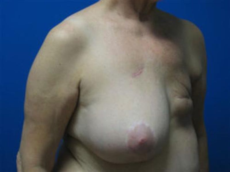 DIEP Flap Before & After Gallery - Patient 263024 - Image 3