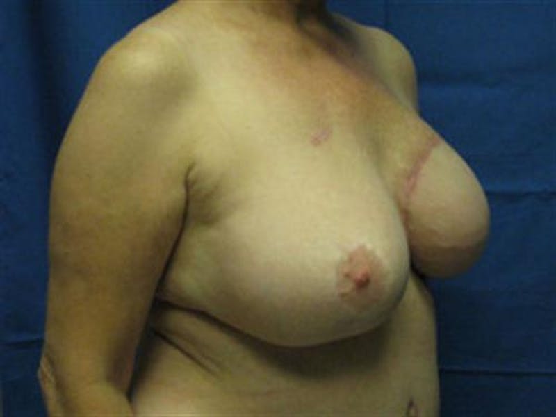 DIEP Flap Before & After Gallery - Patient 263024 - Image 4