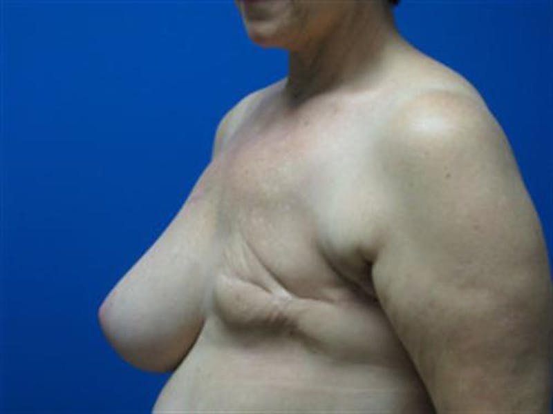DIEP Flap Before & After Gallery - Patient 263024 - Image 5