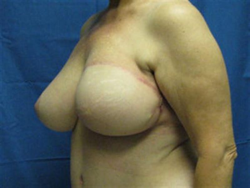 DIEP Flap Before & After Gallery - Patient 263024 - Image 6