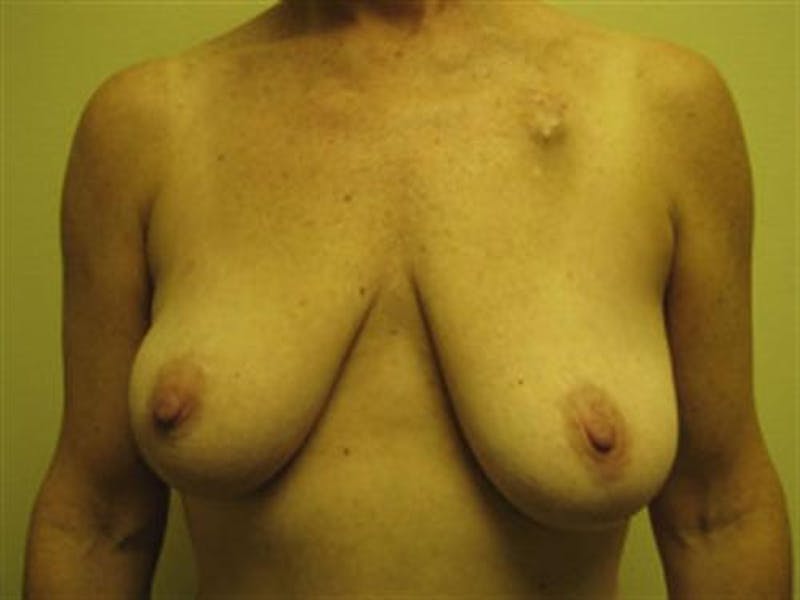 DIEP Flap Before & After Gallery - Patient 205059 - Image 1
