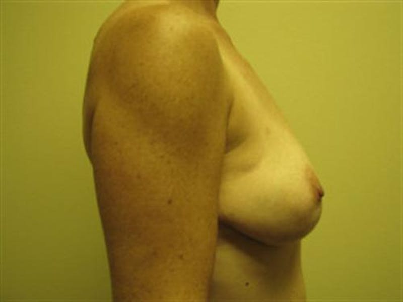 DIEP Flap Before & After Gallery - Patient 205059 - Image 5