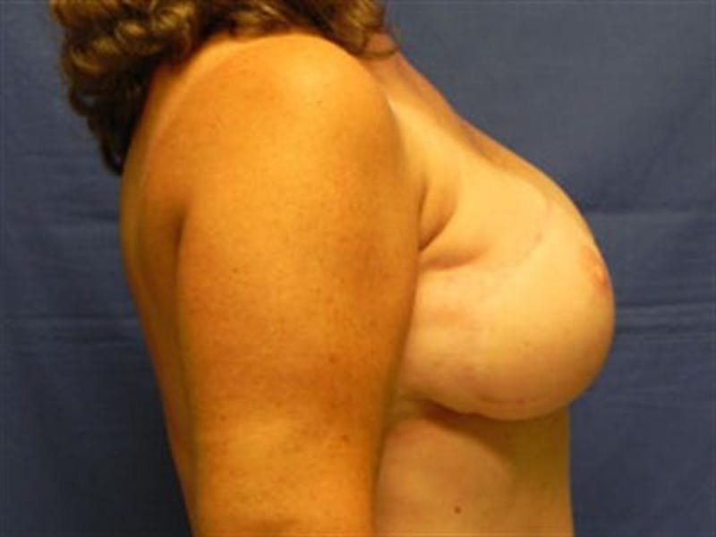 DIEP Flap Before & After Gallery - Patient 205059 - Image 6