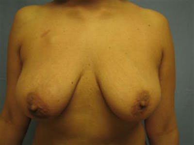DIEP Flap Before & After Gallery - Patient 162511 - Image 1