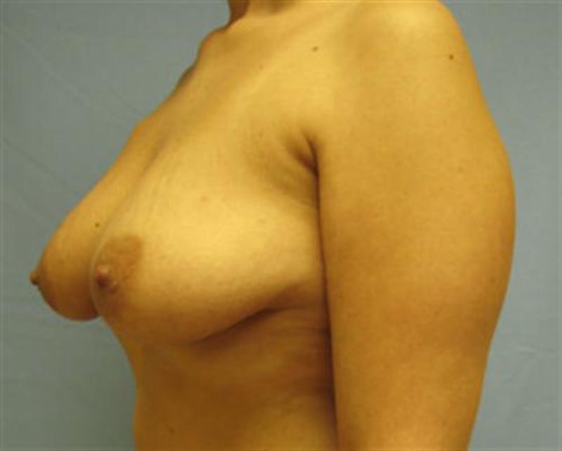 DIEP Flap Before & After Gallery - Patient 162511 - Image 3