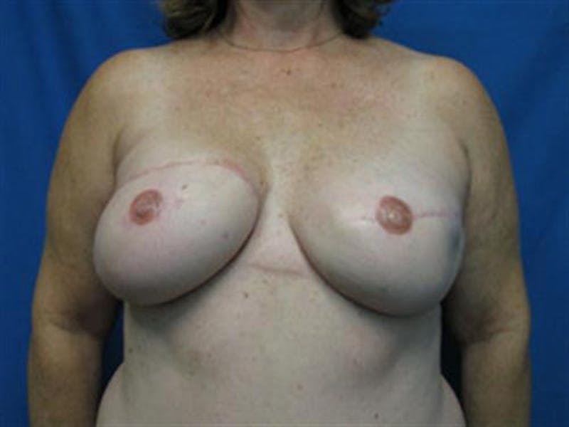DIEP Flap Before & After Gallery - Patient 254609 - Image 2