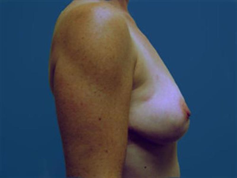 DIEP Flap Before & After Gallery - Patient 254609 - Image 3