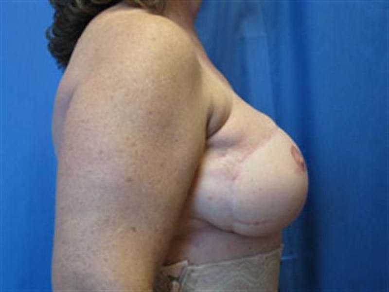 DIEP Flap Before & After Gallery - Patient 254609 - Image 4