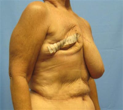 DIEP Flap Before & After Gallery - Patient 409205 - Image 1
