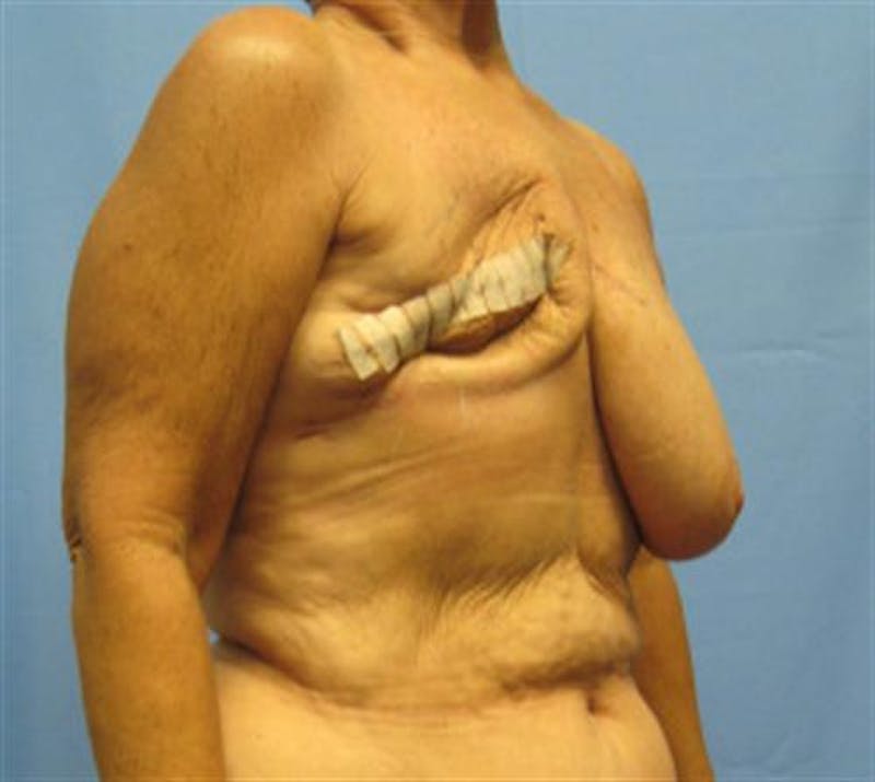 DIEP Flap Before & After Gallery - Patient 409205 - Image 1