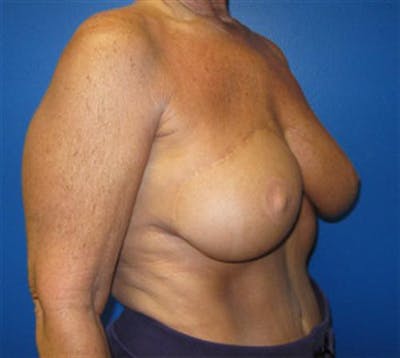 DIEP Flap Before & After Gallery - Patient 409205 - Image 2