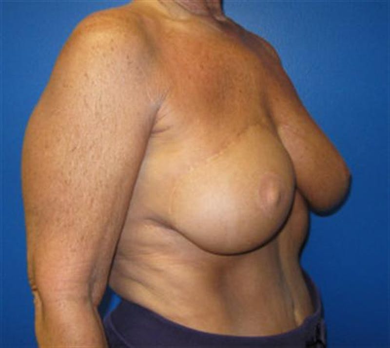 DIEP Flap Before & After Gallery - Patient 409205 - Image 2