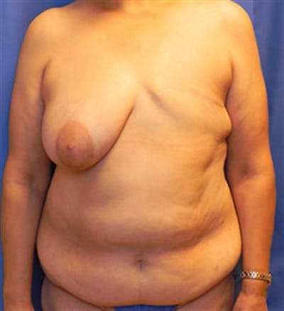 DIEP Flap Before & After Gallery - Patient 380696 - Image 1