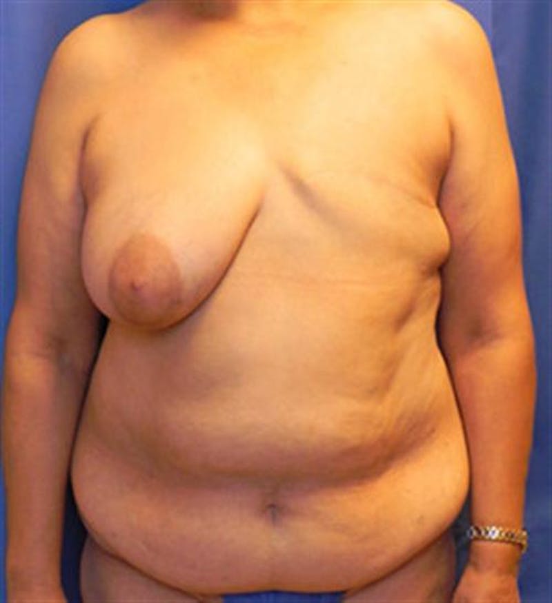 DIEP Flap Before & After Gallery - Patient 380696 - Image 1
