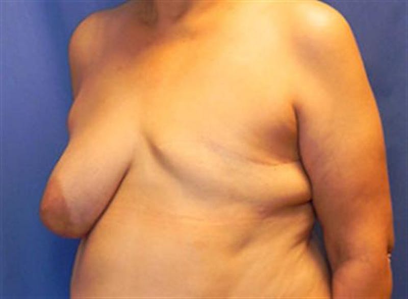DIEP Flap Before & After Gallery - Patient 380696 - Image 3
